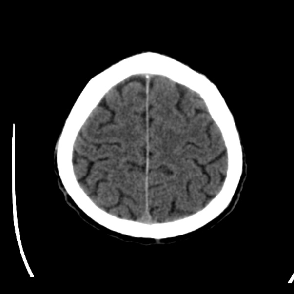 Brain metastases from lung cancer (Radiopaedia 24480-24781 Axial non-contrast 42).jpg