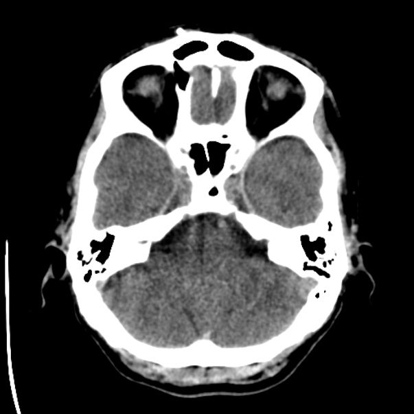 Brain metastases from lung cancer (Radiopaedia 24480-24781 Axial non-contrast 9).jpg