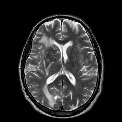 File:Brain metastases from lung cancer (Radiopaedia 83839-99028 Axial T2 20).jpg