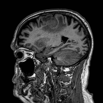 Brain metastases from lung cancer (Radiopaedia 83839-99028 Sagittal T1 86).jpg