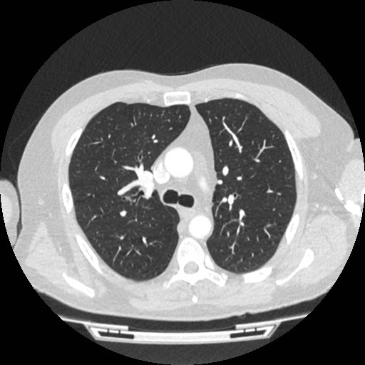 File:Brain metastases from lung cancer (Radiopaedia 83839-99030 Axial lung window 24).jpg