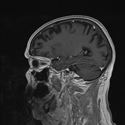 Brain metastasis (Radiopaedia 42617-45761 Sagittal T1 C+ 67).jpg