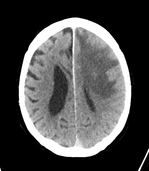 File:Brain metastasis (lung cancer) (Radiopaedia 48289-53177 Axial non-contrast 22).png