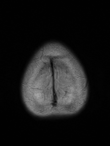 File:Brain metastasis as initial presentation of non-small cell lung cancer (Radiopaedia 65122-74126 Axial FLAIR 18).jpg