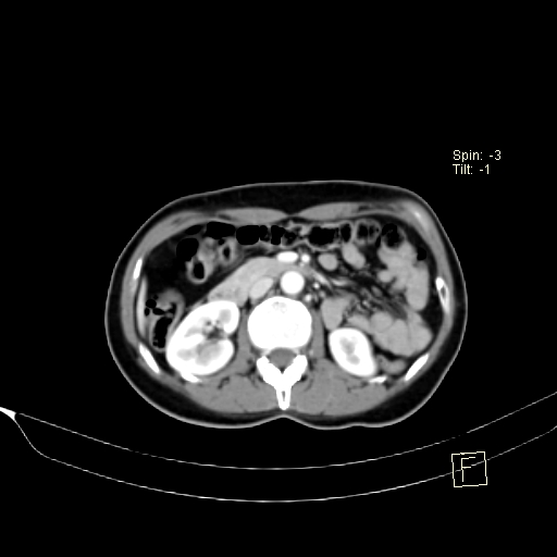 Brain metastasis as initial presentation of non-small cell lung cancer (Radiopaedia 65122-74127 A 62).jpg