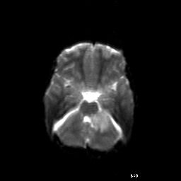 File:Brainstem ganglioglioma (Radiopaedia 10763-11224 Axial DWI 13).jpg