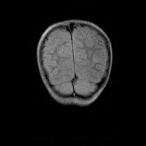 File:Brainstem ganglioglioma (Radiopaedia 10763-11224 Coronal FLAIR 3).jpg
