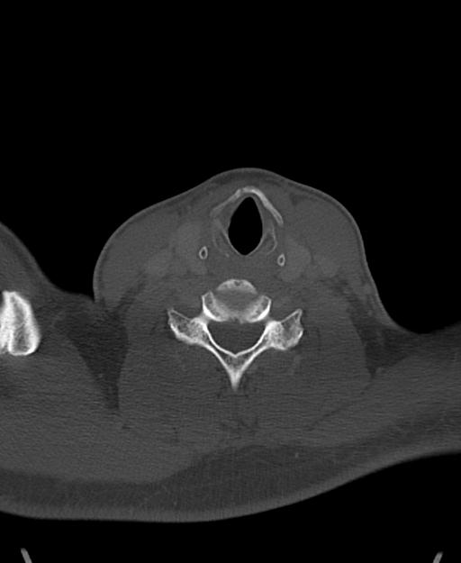 Branchial cleft cyst (Radiopaedia 31167-31875 Axial bone window 51).jpg