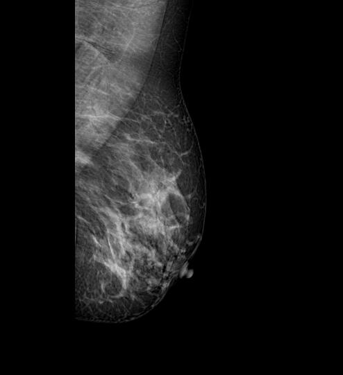 File:Breast abscess (Radiopaedia 72586-83138 L MLO 1).PNG