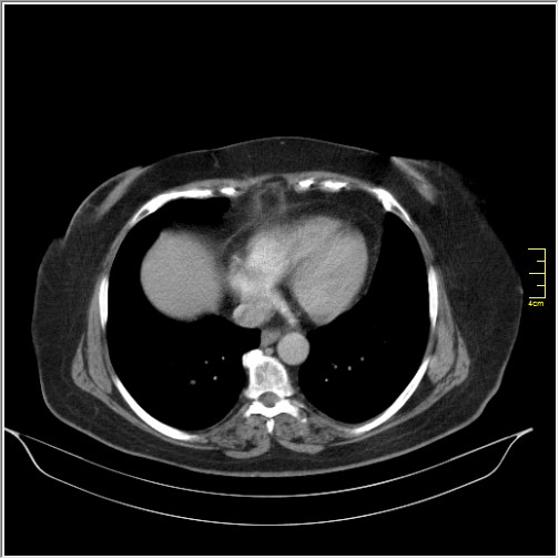 Breast cancer on thorax CT (Radiopaedia 60571-68275 A 75).JPG