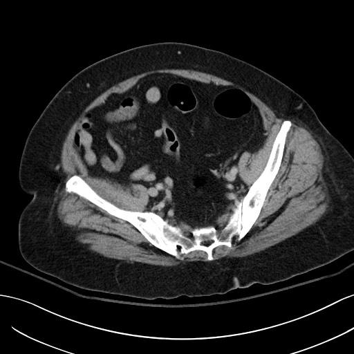 Breast carcinoma with pathological hip fracture (Radiopaedia 60314-67974 B 56).jpg
