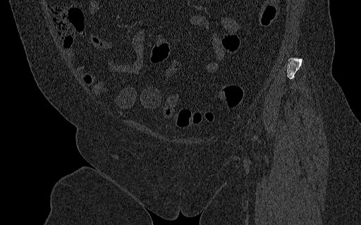 File:Breast carcinoma with pathological hip fracture (Radiopaedia 60314-67993 Coronal bone window 47).jpg