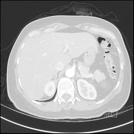 Breast metastases from renal cell cancer (Radiopaedia 79220-92225 Axial lung window 82).jpg