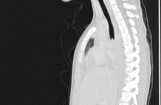 Bronchial mucoepidermoid carcinoma (Radiopaedia 57023-63895 Sagittal lung window 67).jpg