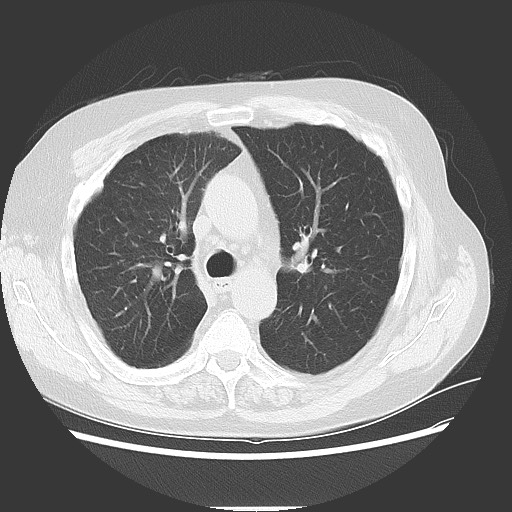 Bronchial stenosis - lung transplant (Radiopaedia 73133-83848 Axial lung window 24).jpg