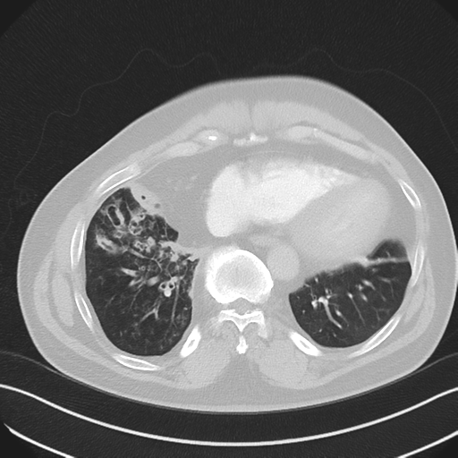 File:Bronchiectasis (Radiopaedia 39385-41666 Axial lung window 48).png