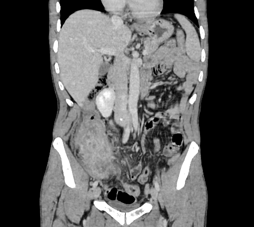 File:Bronchiectasis in Crohn disease (Radiopaedia 60311-67977 C 34).jpg