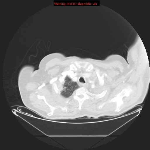 File:Bronchioloalveolar carcinoma (Radiopaedia 9272-9955 Axial lung window 3).jpg