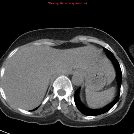 File:Bronchoalveolar carcinoma (BAC) (Radiopaedia 13436-13392 Axial non-contrast 45).jpg
