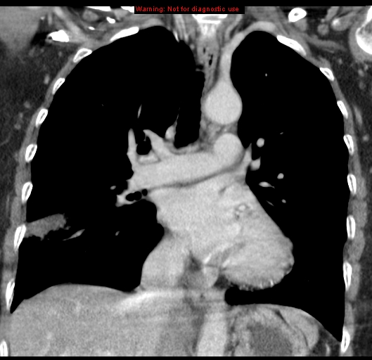 Bronchoalveolar carcinoma (BAC) (Radiopaedia 13436-13392 E 29).jpg