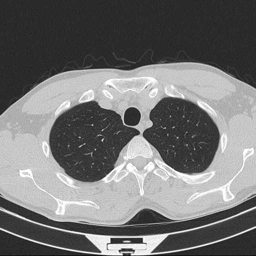 Bronchocele (Radiopaedia 60676-68429 Axial lung window 11).jpg