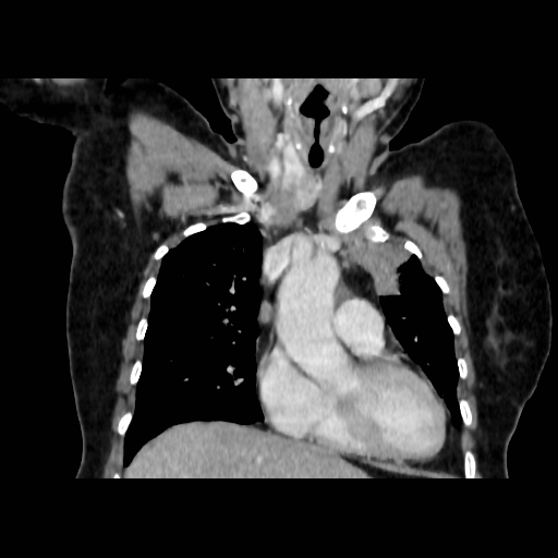 Bronchogenic carcinoma (Radiopaedia 73497-84262 C 50).jpg