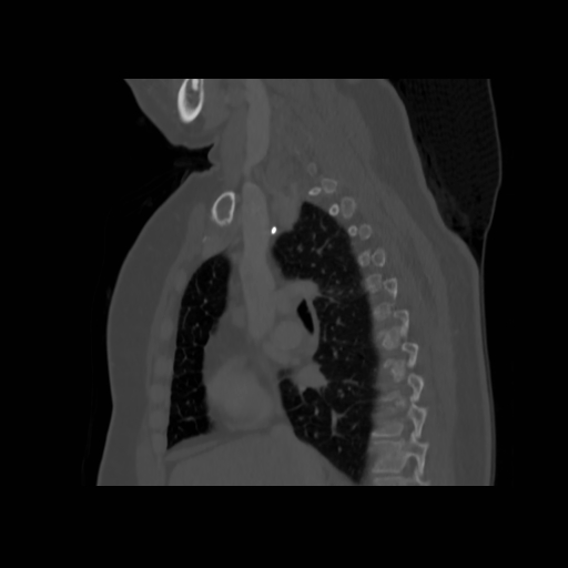 Bronchogenic carcinoma (Radiopaedia 73497-84262 Sagittal bone window 71).jpg