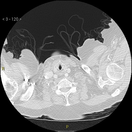 File:Bronchogenic carcinoma as an incidental finding (Radiopaedia 16453-16130 Axial lung window 120).jpg