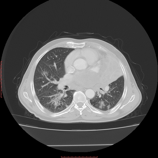 File:Bronchogenic carcinoma with left atrial large deposit - T4N3M1a (Radiopaedia 42316-45428 Axial lung window 16).jpg