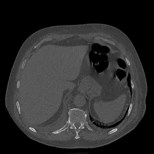 Bronchogenic carcinoma with metastatic lymphadenopathy (Radiopaedia 37671-39569 Axial bone window 49).jpg