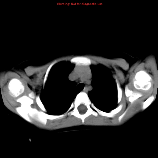 File:Bronchogenic cyst (Radiopaedia 9372-10063 Axial non-contrast 5).jpg