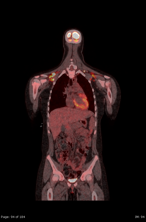 Brown fat uptake (FDG PET-CT) (Radiopaedia 77392-89513 Fused coronal 52).jpg