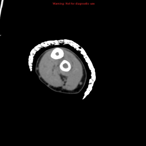 Brown tumor (Radiopaedia 12460-12694 Axial non-contrast 113).jpg
