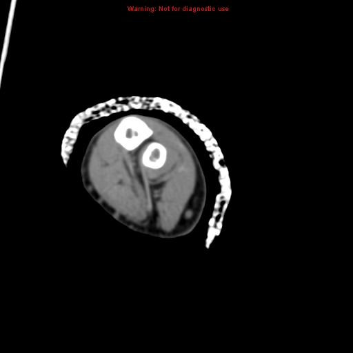 Brown tumor (Radiopaedia 12460-12694 Axial non-contrast 120).jpg
