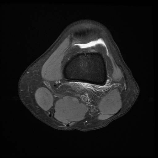 File:Bucket-handle meniscus tear (Radiopaedia 65700-74809 Axial PD fat sat 7).jpg