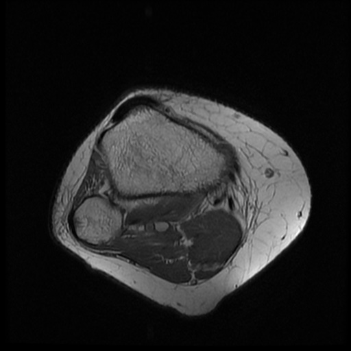 File:Bucket handle meniscus tear (Radiopaedia 56916-63751 Axial PD 19).jpg