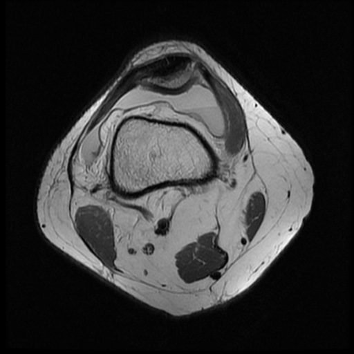 File:Bucket handle meniscus tear (Radiopaedia 56916-63751 Axial PD 2).jpg