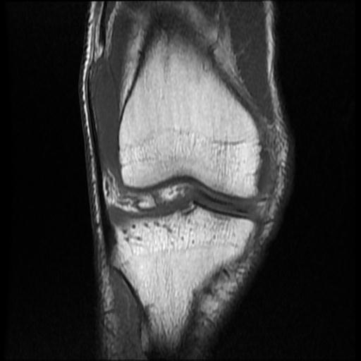 File:Bucket handle tear - medial meniscus (Radiopaedia 69245-79026 Coronal T1 7).jpg
