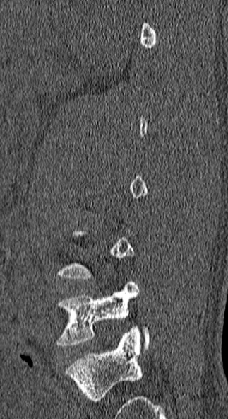 Burst fracture (Radiopaedia 53373-59357 Sagittal bone window 68).jpg