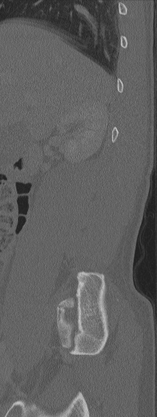 Burst fracture - T12 with conus compression (Radiopaedia 56825-63647 Sagittal bone window 78).png