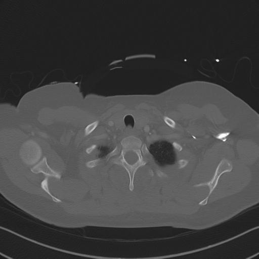 Burst fracture - thoracic spine (Radiopaedia 30238-30865 Axial bone window 15).jpg