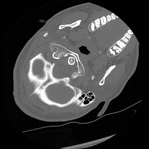 C1-C2 "subluxation" - normal cervical anatomy at maximum head rotation (Radiopaedia 42483-45607 Axial non-contrast 57).jpg