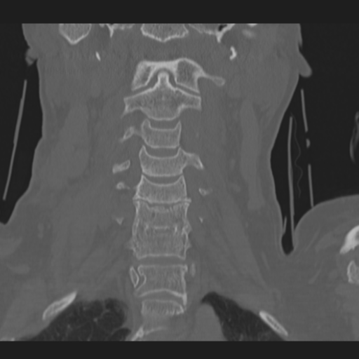 File:C2 fracture (Radiopaedia 34091-35341 Coronal bone window 19).png
