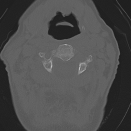 File:C2 fracture with vertebral artery dissection (Radiopaedia 37378-39199 Axial bone window 19).png
