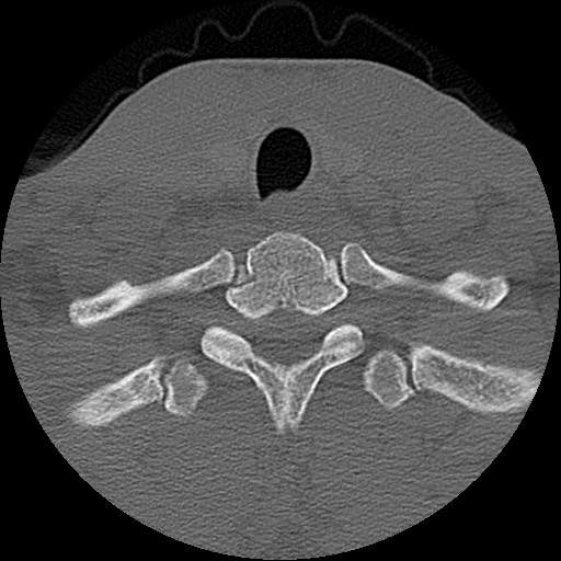 File:C5 facet fracture (Radiopaedia 58374-65499 Axial bone window 83).jpg