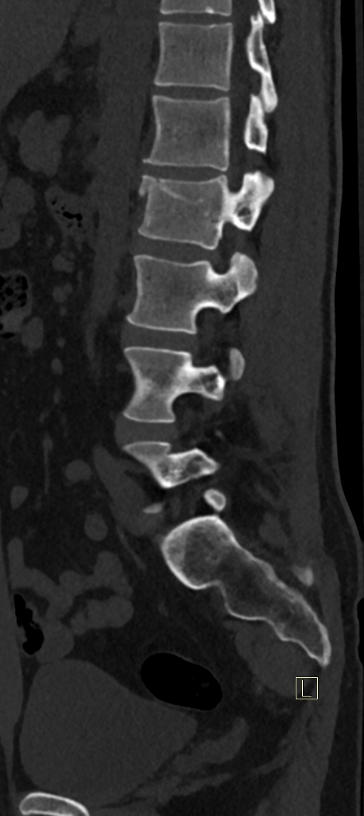 Calcaneal fractures with associated L2 burst fracture (Radiopaedia 71671-82493 Sagittal bone window 24).jpg
