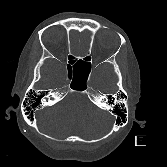 Calcified chronic subdural hematoma (Radiopaedia 77374-89492 Axial bone window 28).jpg