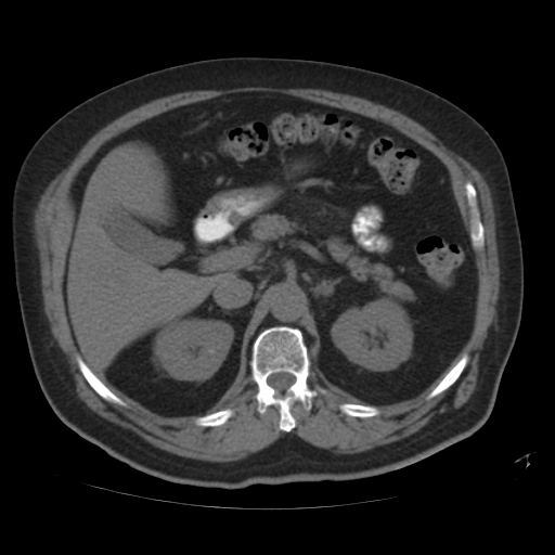 File:Calcified hepatic hydatid cyst (Radiopaedia 18907-18853 Axial non-contrast 19).jpg