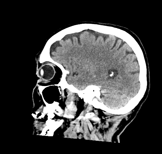 File:Calcified meningioma (Radiopaedia 74361-85243 D 14).jpg