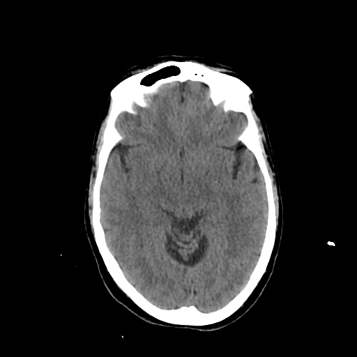 File:Calcified meningioma - cervical canal (Radiopaedia 70136-80171 Axial non-contrast 12).jpg